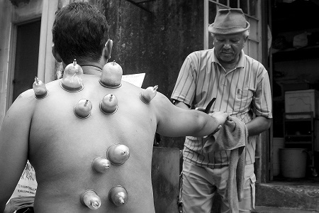 Traditional hot cupping practitioner treating a patient 